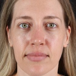 Rhinoplasty Before & After Patient #12227