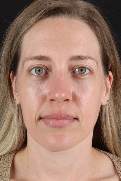 Rhinoplasty Before & After Patient #12227