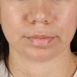Chin Implant Before & After Patient #13783