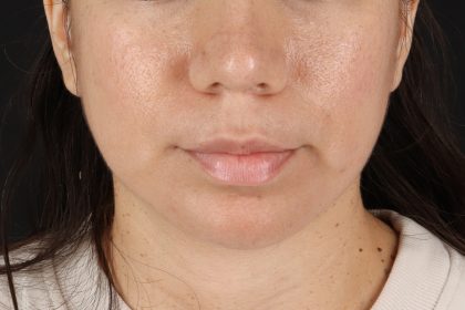 Chin Implant Before & After Patient #13783