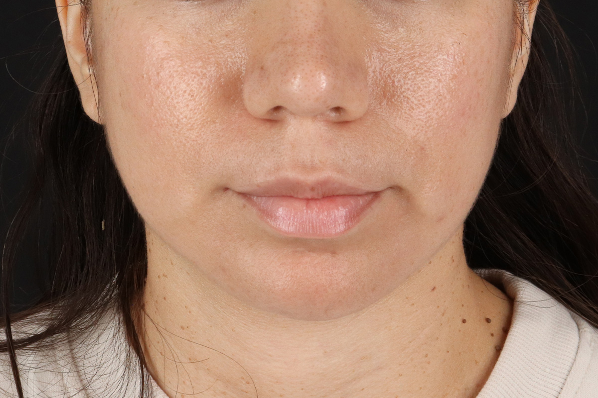 Chin Implant Before & After Patient #13783