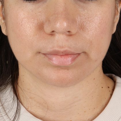 Facelift Before & After Patient #11699