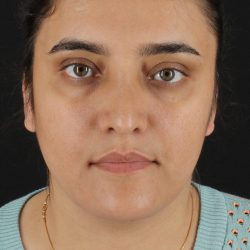 Neck Lift Before & After Patient #11565
