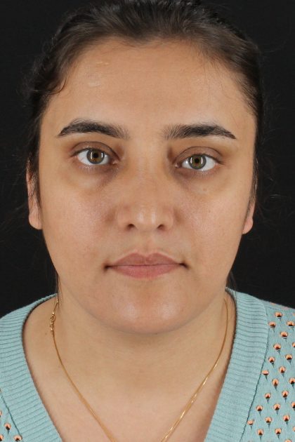 Neck Lift Before & After Patient #11565