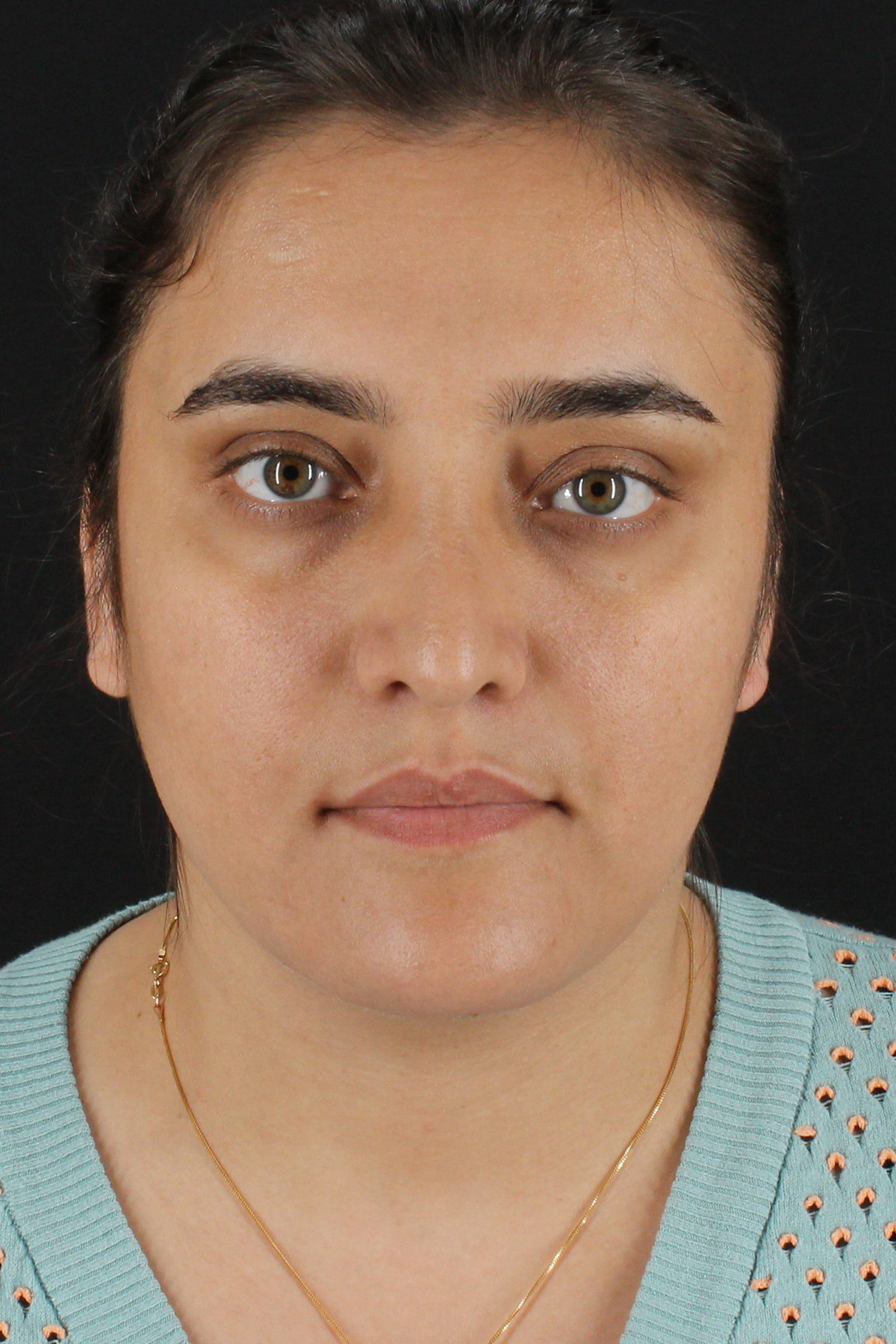 Neck Lift Before & After Patient #11565