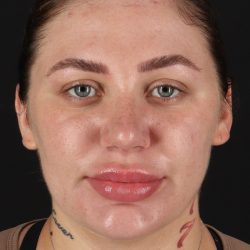 Rhinoplasty Before & After Patient #12403