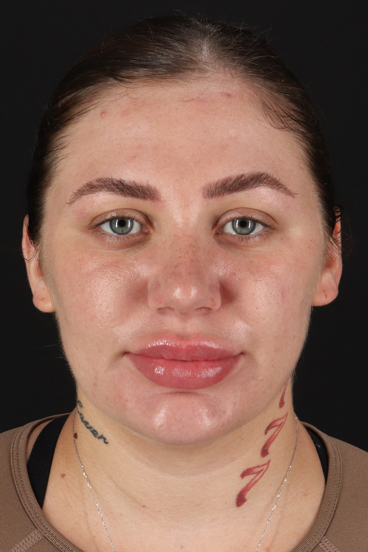 Rhinoplasty Before & After Patient #12403