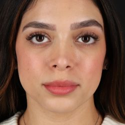Rhinoplasty Before & After Patient #12249