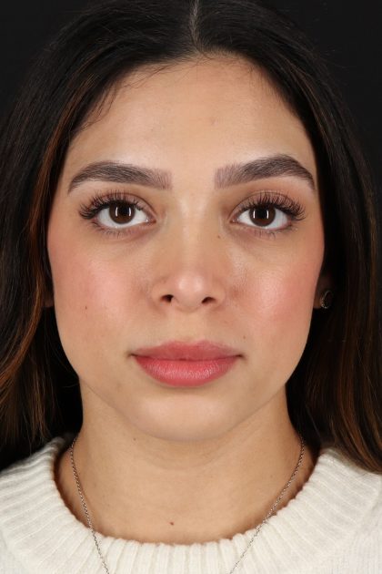 Rhinoplasty Before & After Patient #12249