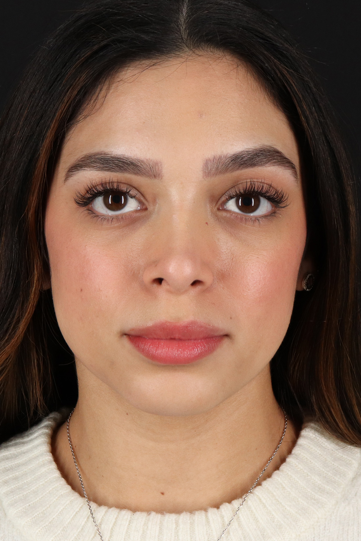 Rhinoplasty Before & After Patient #12249