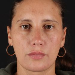 Chin Implant Before & After Patient #13728