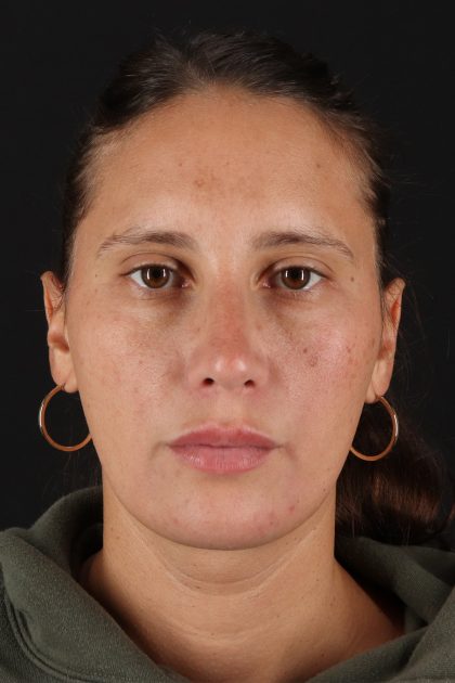 Chin Implant Before & After Patient #13728