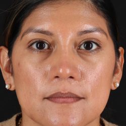 Rhinoplasty Before & After Patient #12337