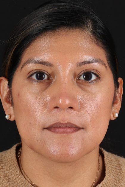 Rhinoplasty Before & After Patient #12337