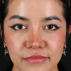 Fillers Before & After Patient #13298