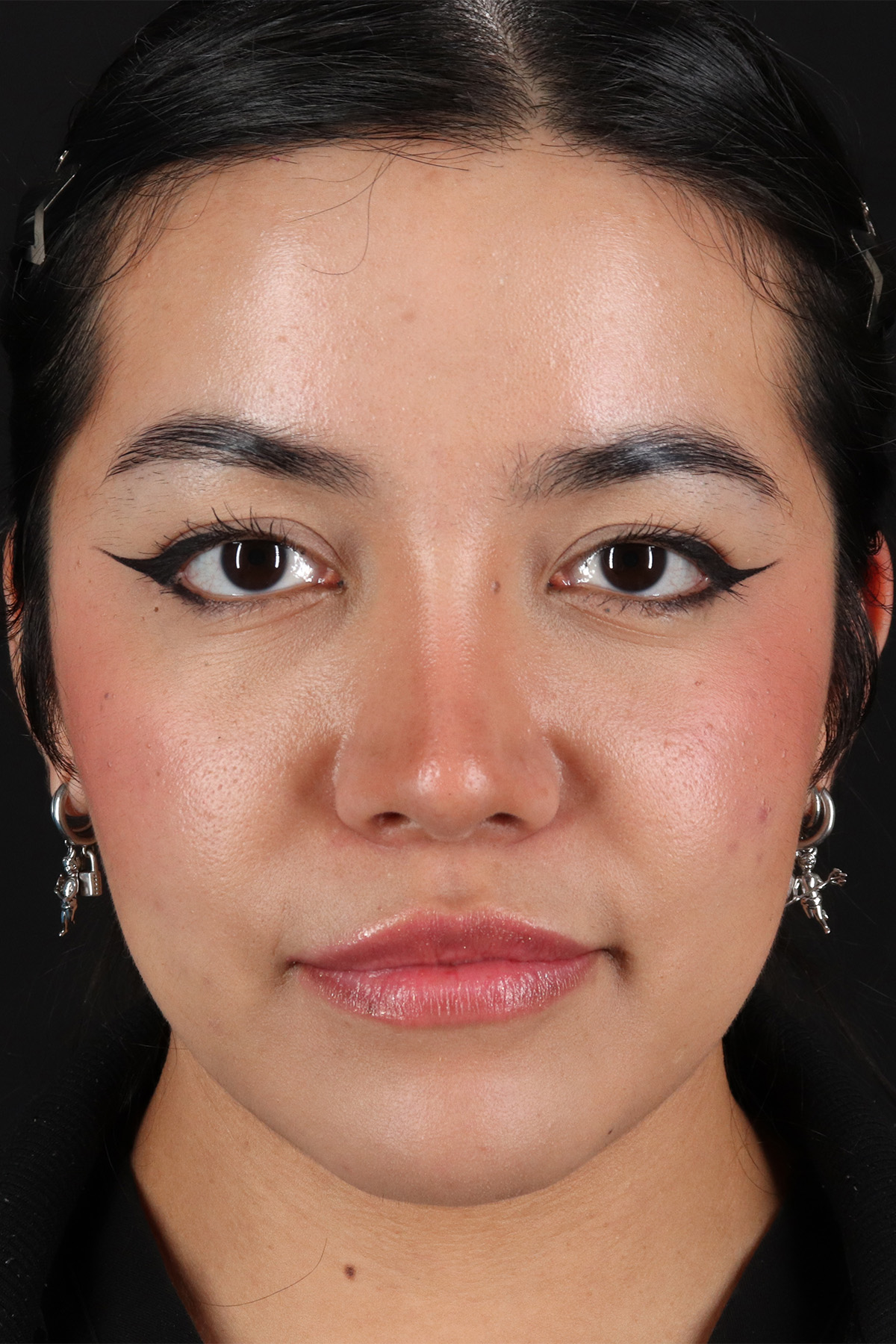 Fillers Before & After Patient #13298