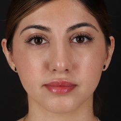 Rhinoplasty Before & After Patient #12304