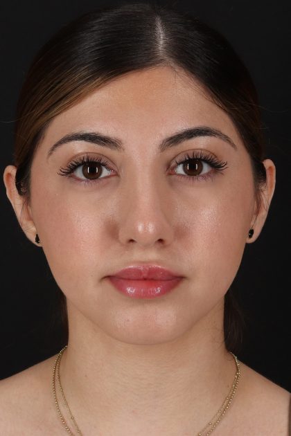 Rhinoplasty Before & After Patient #12304