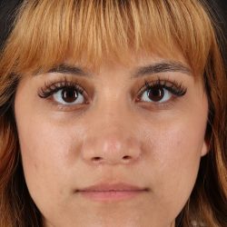 Rhinoplasty Before & After Patient #12469