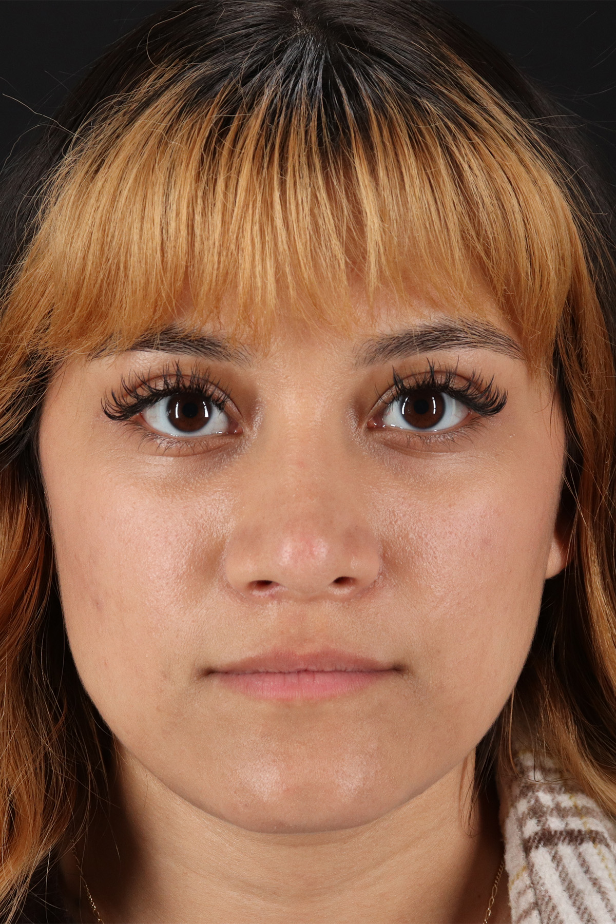 Rhinoplasty Before & After Patient #12469