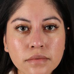 Fillers Before & After Patient #13276