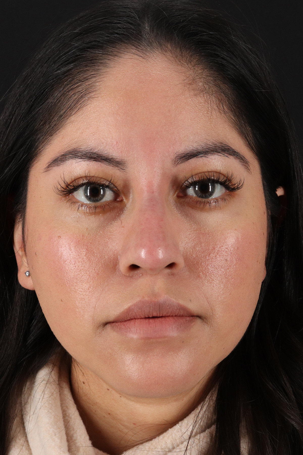 Fillers Before & After Patient #13276