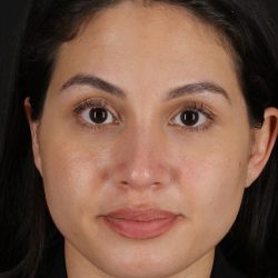 Rhinoplasty Before & After Patient #12282