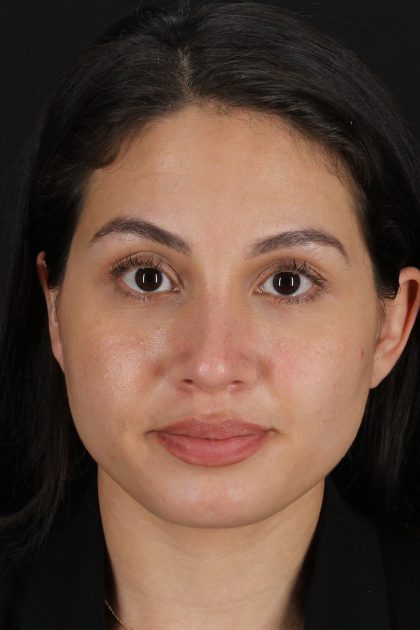 Rhinoplasty Before & After Patient #12282