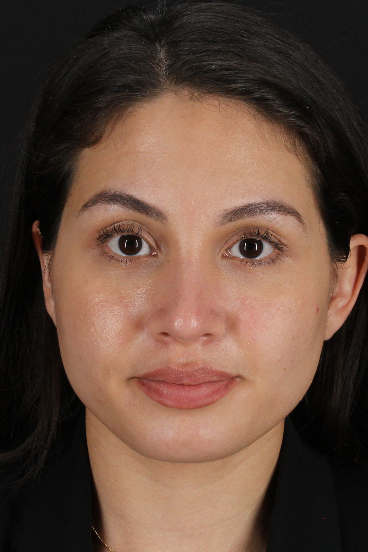 Rhinoplasty Before & After Patient #12282