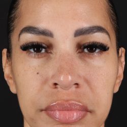 Chin Implant Before & After Patient #11693
