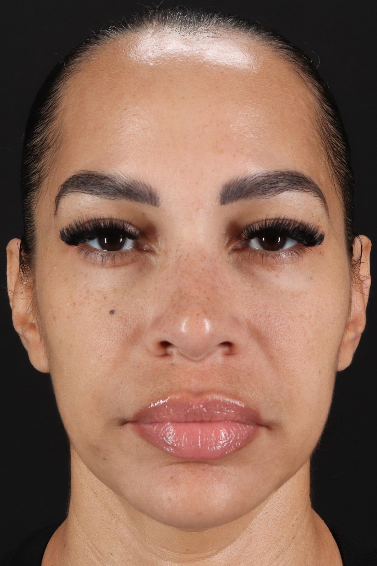 Chin Implant Before & After Patient #11693