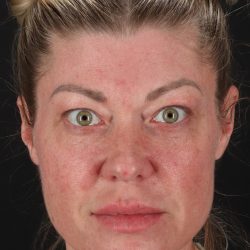 Lower Blepharoplasty Before & After Patient #13030