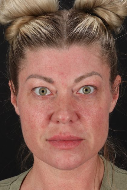 Lower Blepharoplasty Before & After Patient #13030