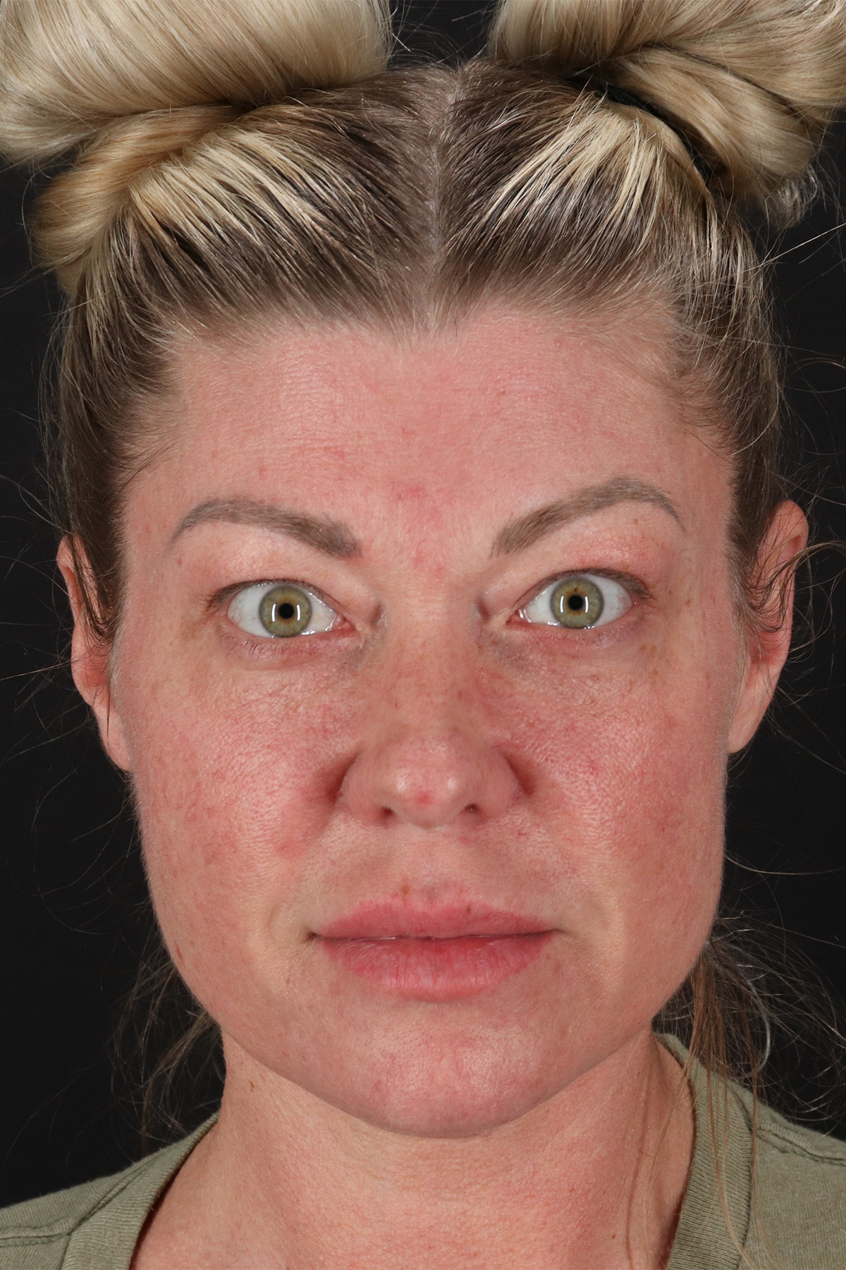 Lower Blepharoplasty Before & After Patient #13030