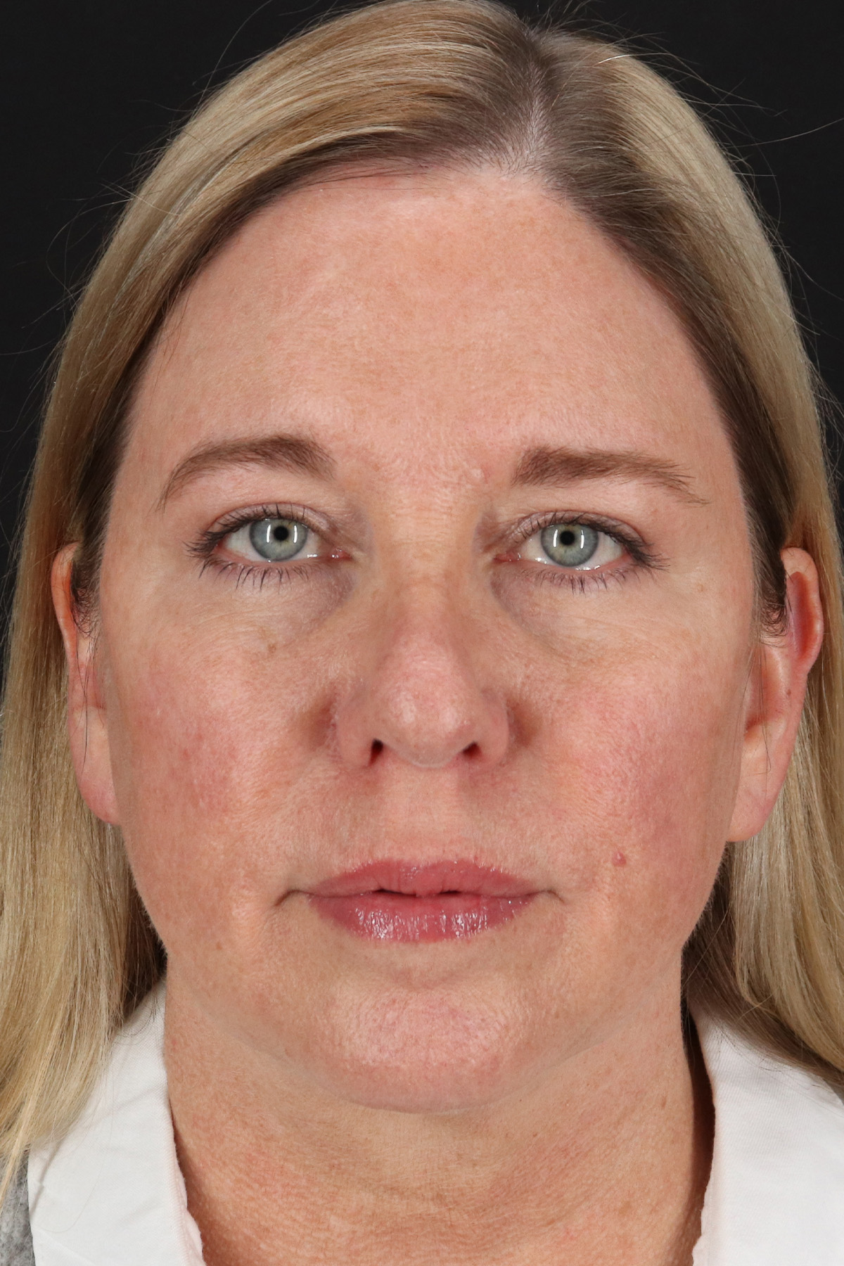 Rhinoplasty Before & After Patient #12194