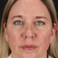 Lower Blepharoplasty Before & After Patient #13041