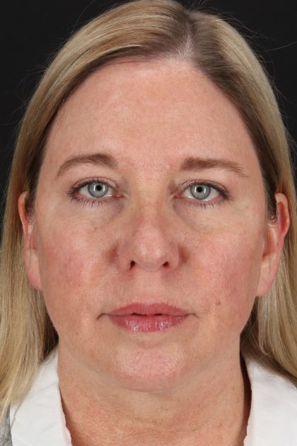 Lower Blepharoplasty Before & After Patient #13041
