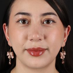 Rhinoplasty Before & After Patient #12359