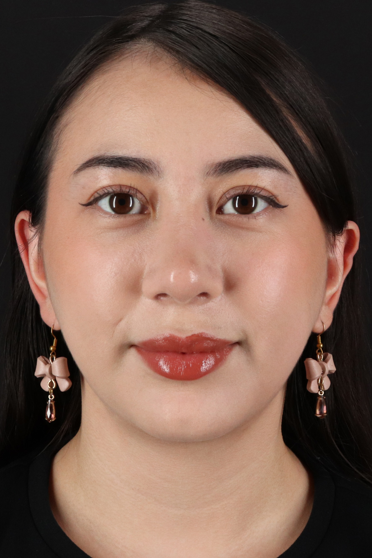 Rhinoplasty Before & After Patient #12359