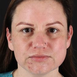 Chemical Peels Before & After Patient #11070