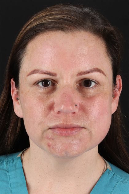 Chemical Peels Before & After Patient #11070