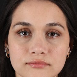Rhinoplasty Before & After Patient #12260