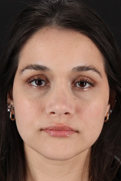 Rhinoplasty Before & After Patient #12260