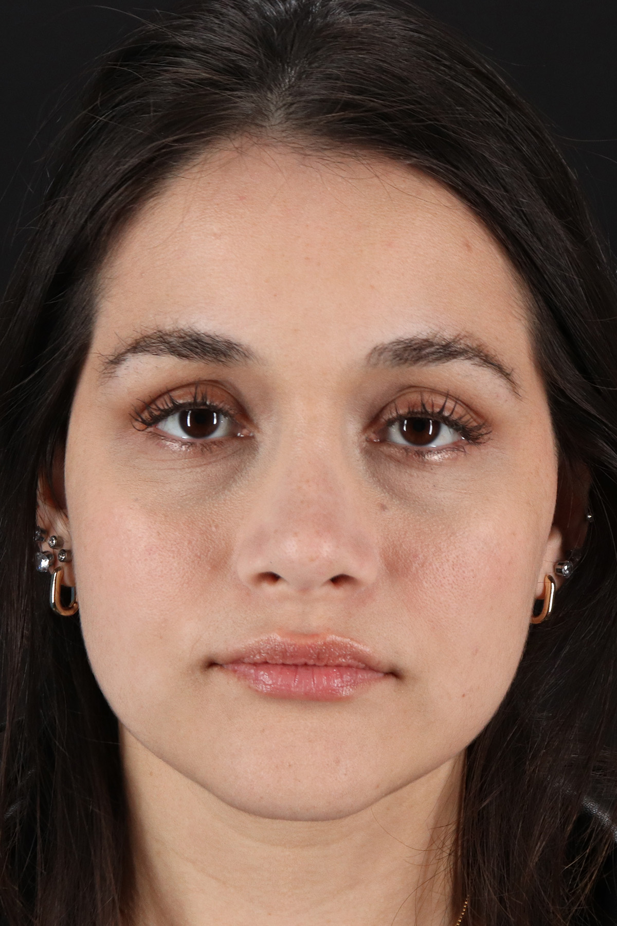 Rhinoplasty Before & After Patient #12260
