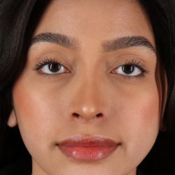 Chin Implant Before & After Patient #13706