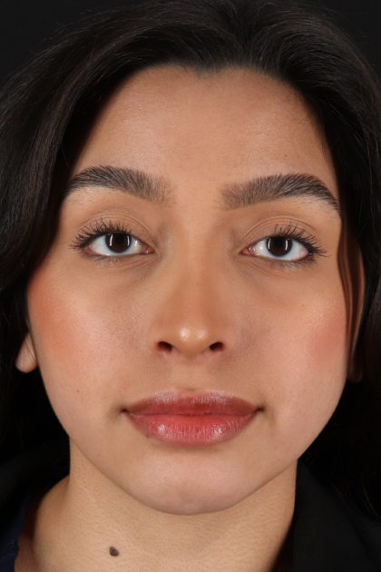 Chin Implant Before & After Patient #13706