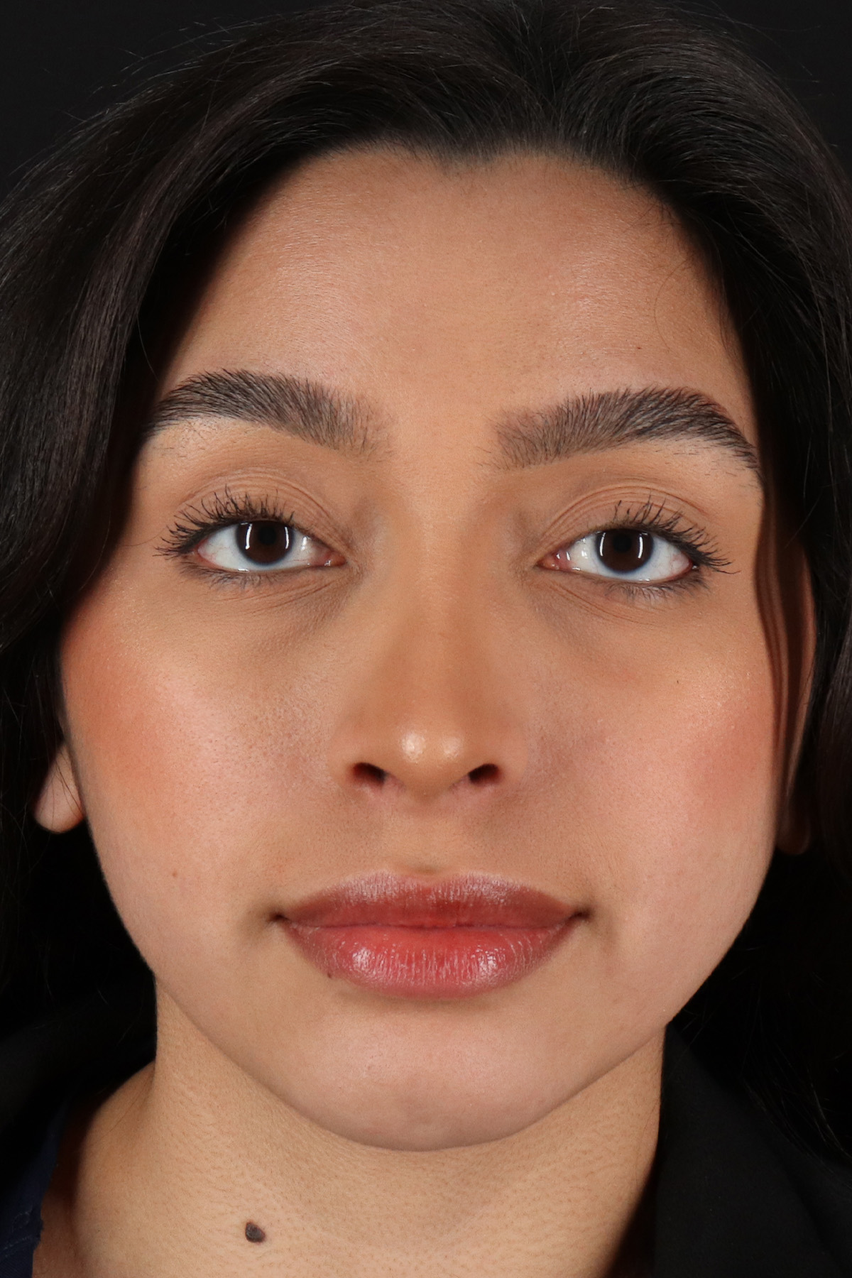 Chin Implant Before & After Patient #13706