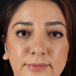 Rhinoplasty Before & After Patient #12392