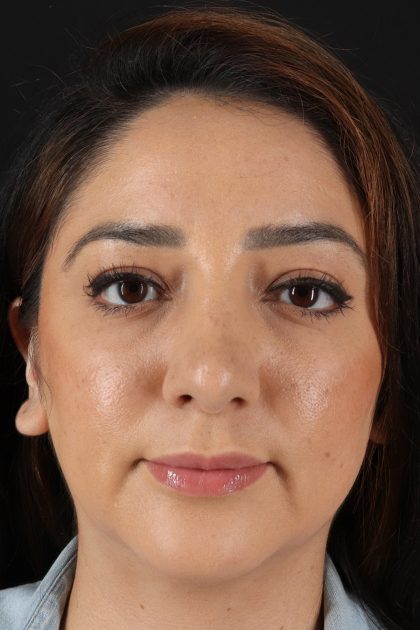 Rhinoplasty Before & After Patient #12392