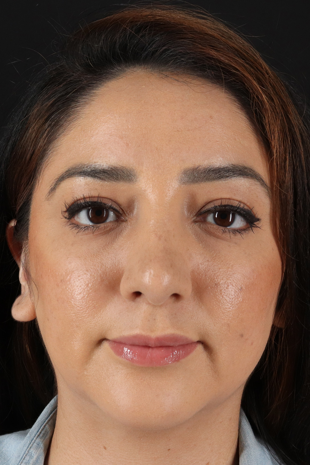 Rhinoplasty Before & After Patient #12392